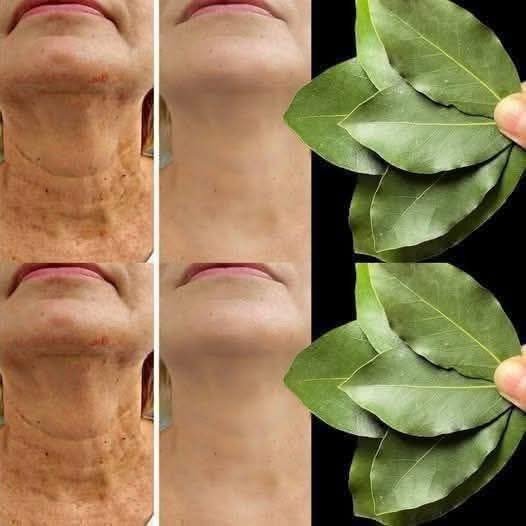 The Viral Bay Leaf “Botox” Trend: Separation of Myth vs. Fact for Ageless Skin