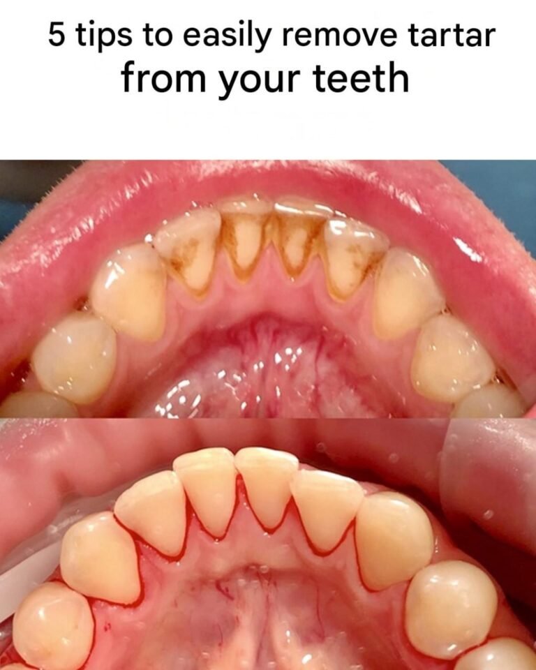 Home remedies to remove tartar from teeth