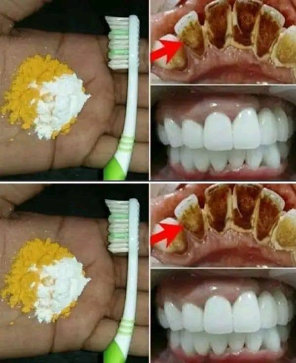 Home Teeth Whitening Get Whiter Teeth in Just 2 Minutes
