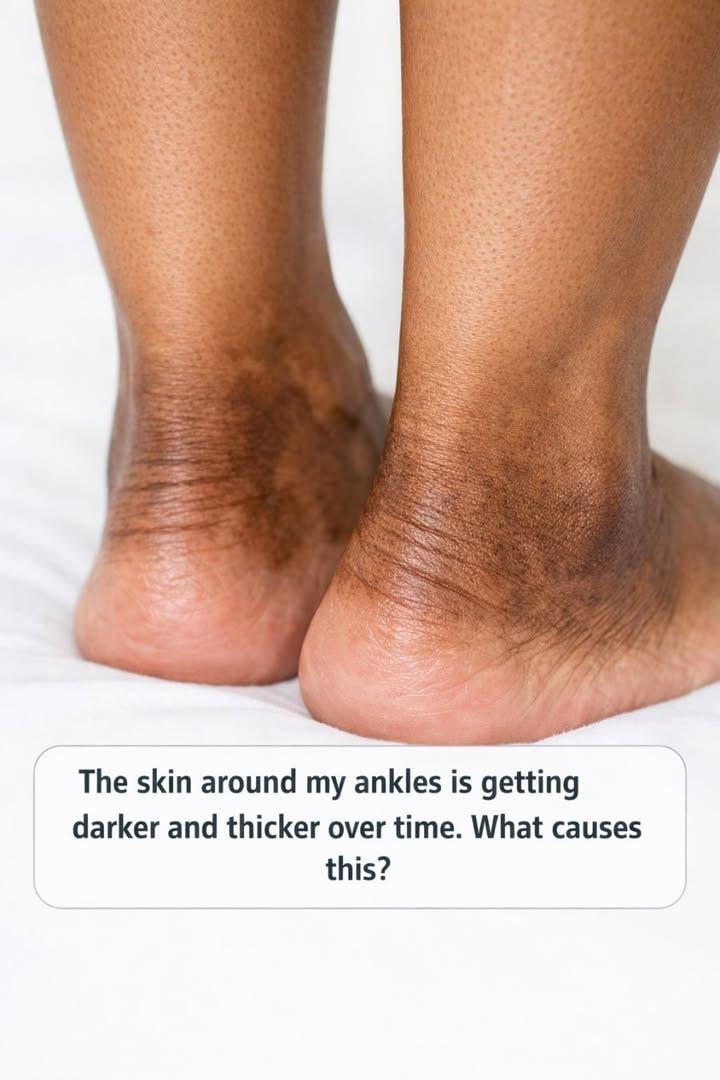 The skin around my ankles is getting darker and thicker over time. What causes this