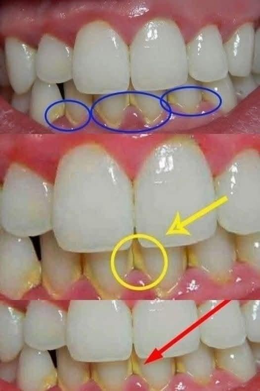 Remove dental plaque in 5 minutes naturally