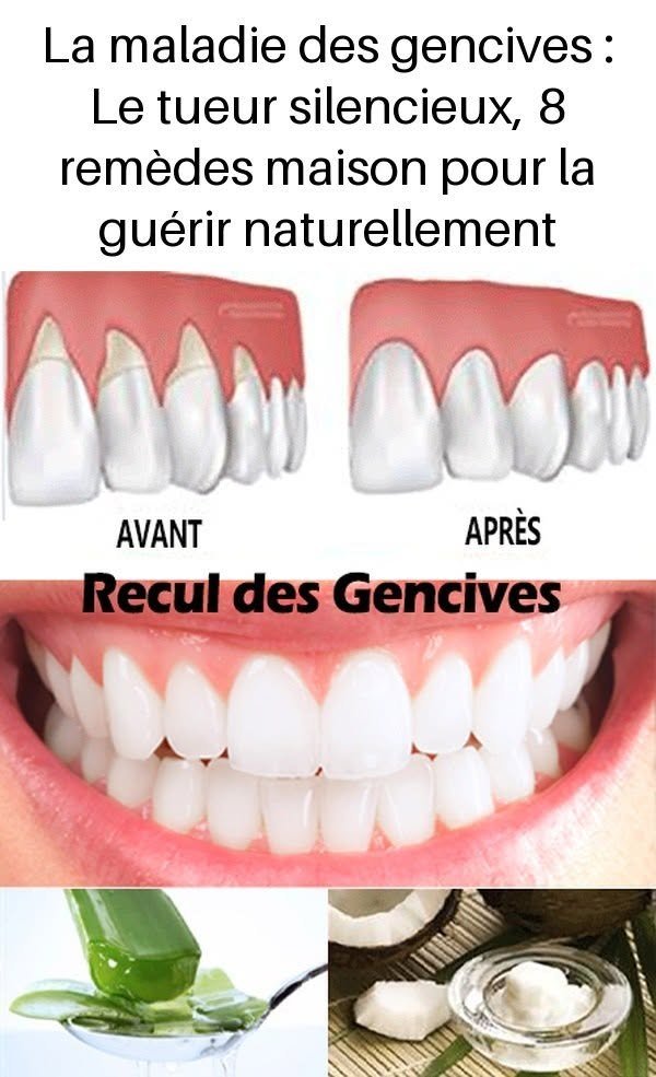Gum disease: The silent killer, 8 home remedies to cure it naturally
