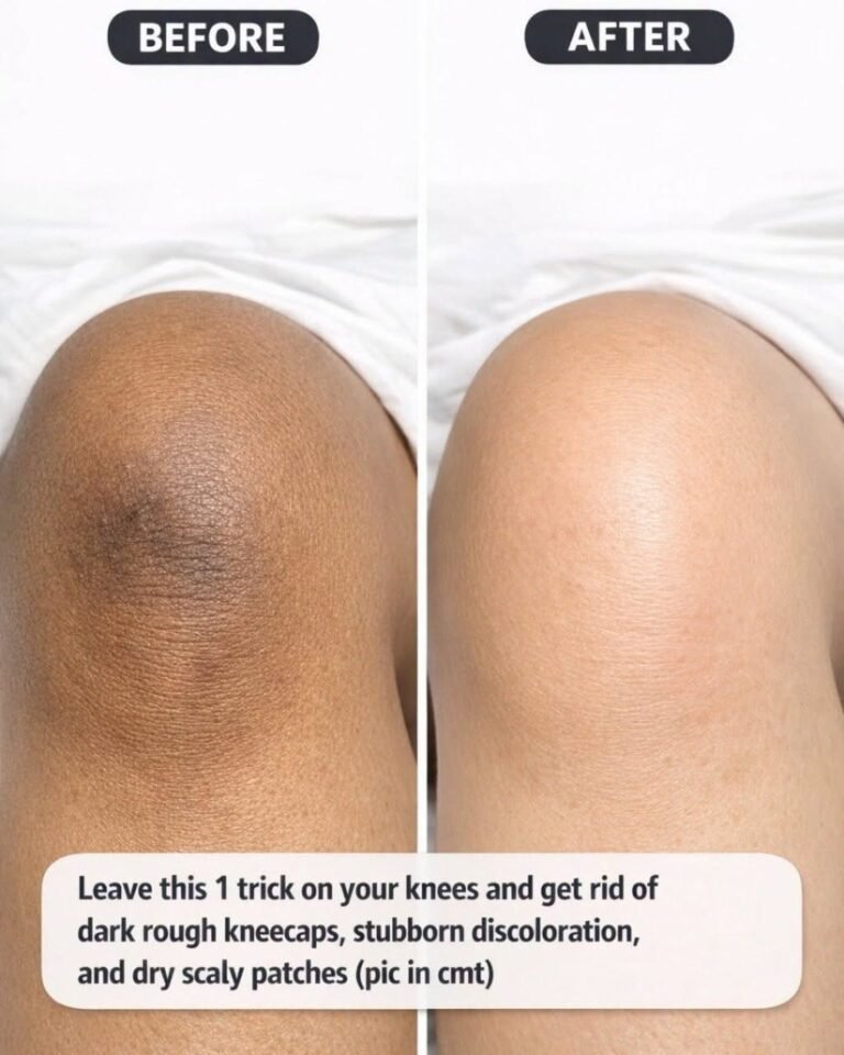 Leave this 1 trick on your knees and get rid of dark rough kneecaps, stubborn discoloration, and dry scaly patchesDetails in the first C0m.ment 