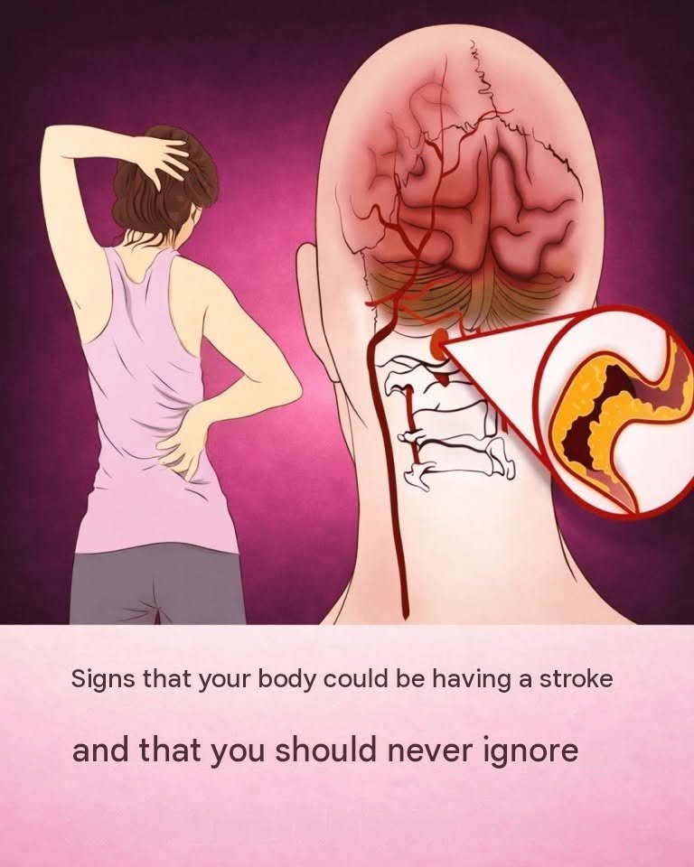 10 early warning signs of a stroke that everyone should know in order to act immediately.
